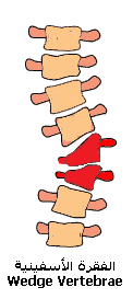 Scoliosis Scoliosis (8).gif